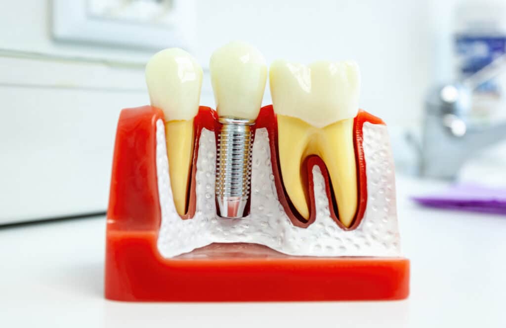 Modelo de implante dental unitario