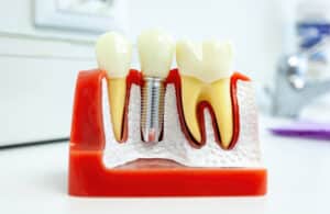 Modelo de implante dental unitario