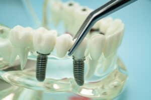 Modelo de demostración de puente dental