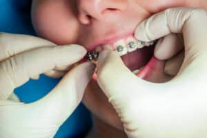 Dentista examina los brackets de un paciente