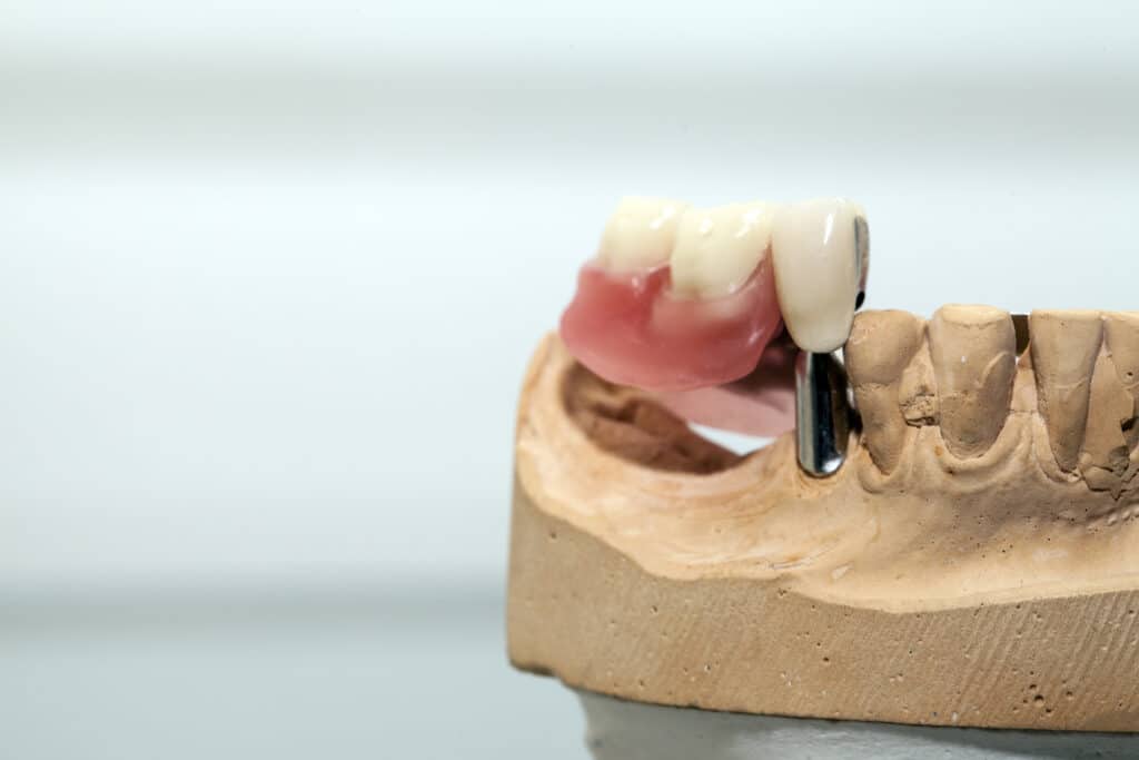 Prótesis dental fija sobre implantes sobre un modelo de dentadura de yeso