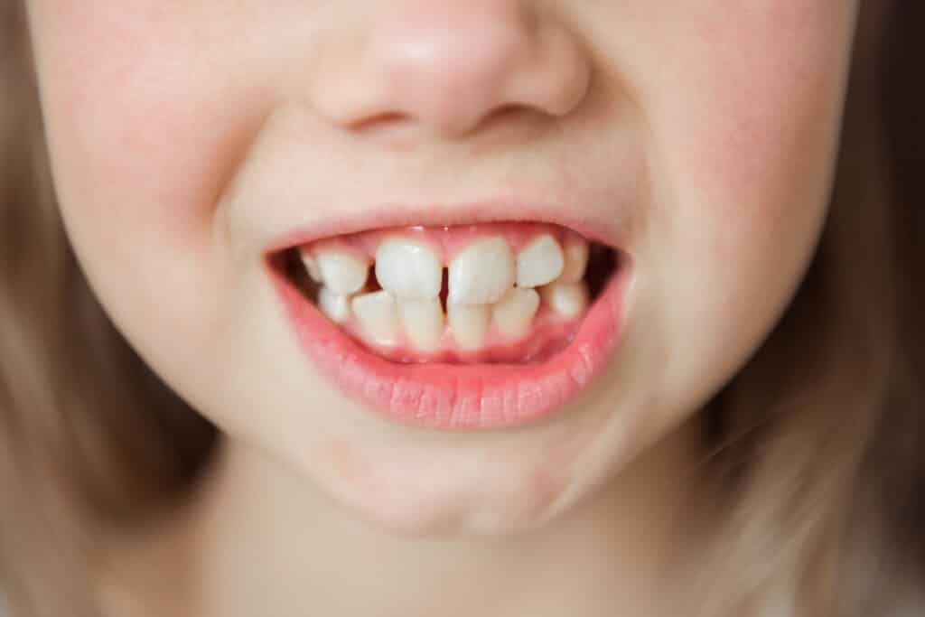 Fotografía de frenectomía en niños