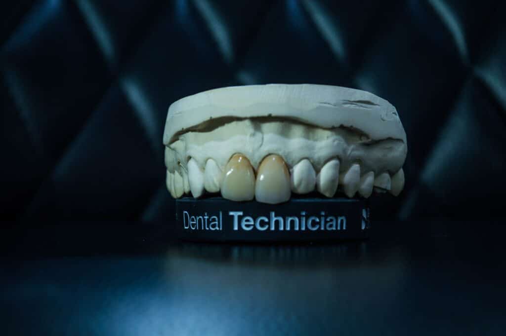 Tratamiento con carillas dentales
